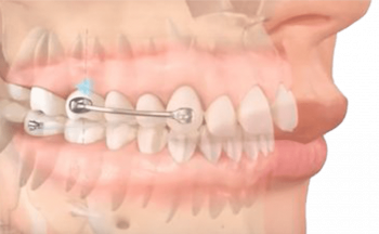 Появилась новая услуга - Ортодонтическое лечение на аппарате Motion 3 D