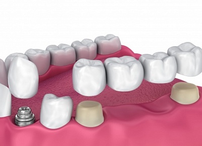 Зубные коронки на имплантах