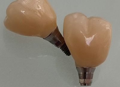Удаление зубов с одномоментной имплантацией