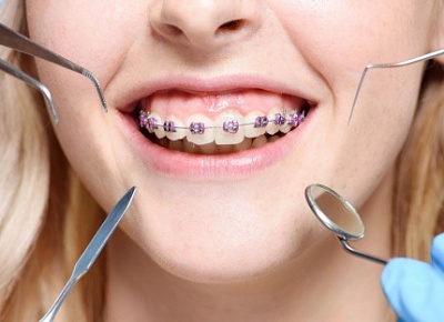 Портятся ли зубы от брекетов?