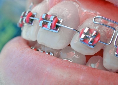 Частичная ортодонтия